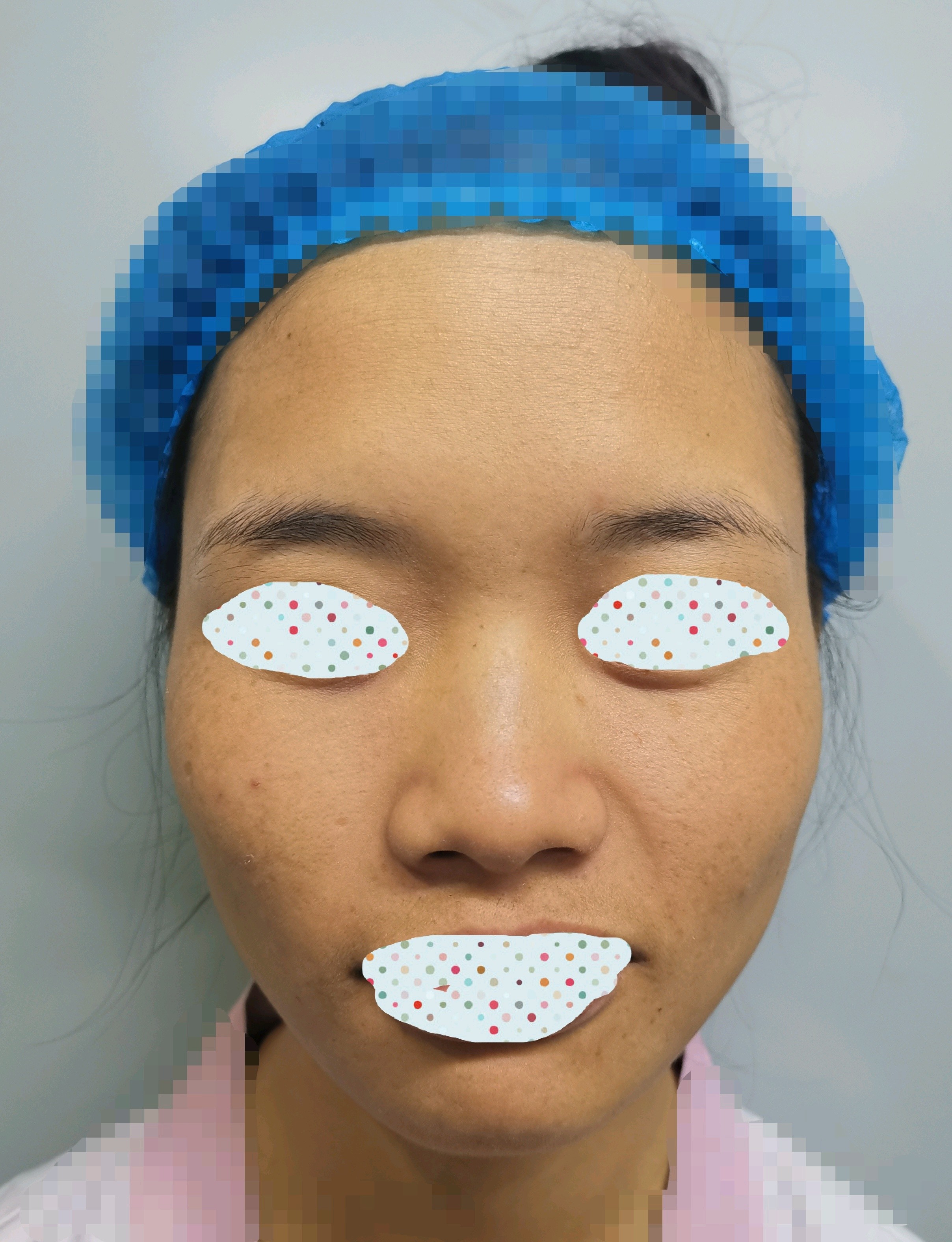 鼻头鼻翼大,鼻头塌,很容易缺乏精致感,自然影响面部_圈子-新氧美容