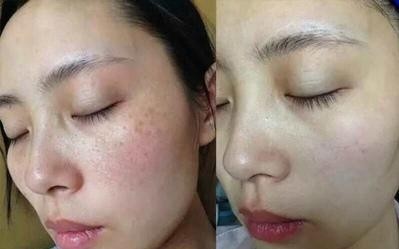 亲自试用|如何去掉脸上的色斑