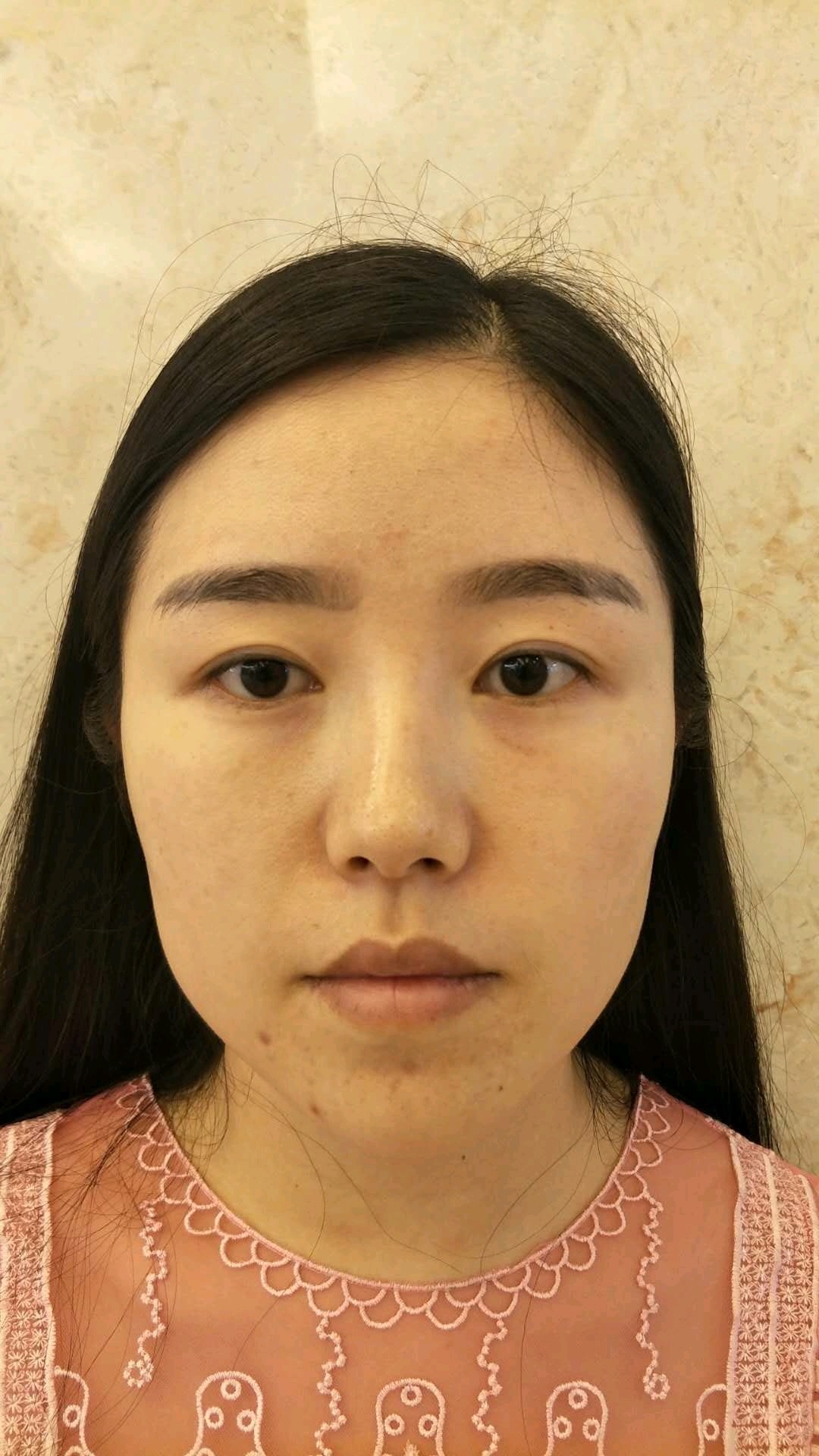 颧弓颧骨降低术塑造柔和之美