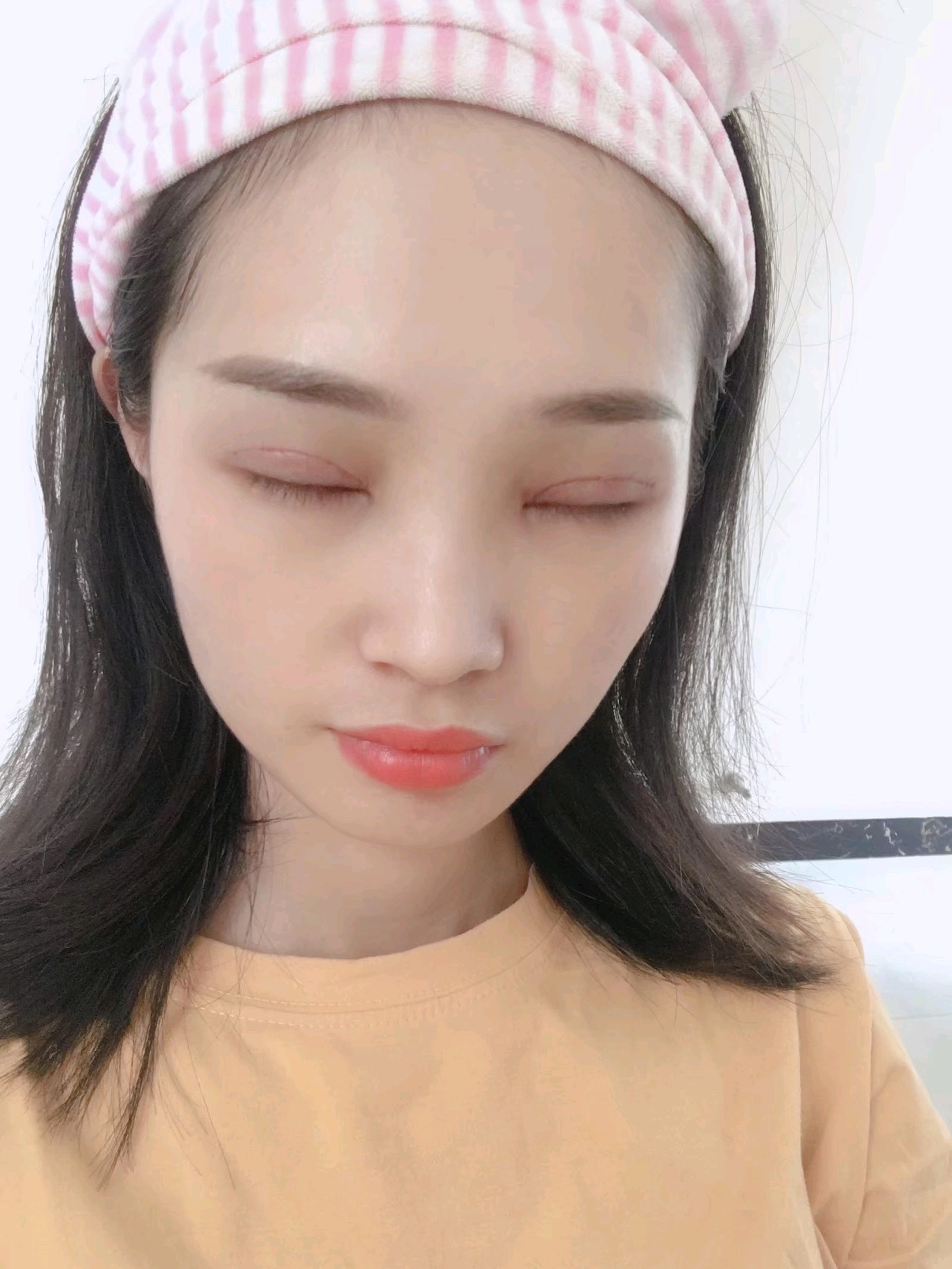 全切双眼皮术后第二天,相比第一天肿胀感减轻一丢丢,_圈子-新氧美容