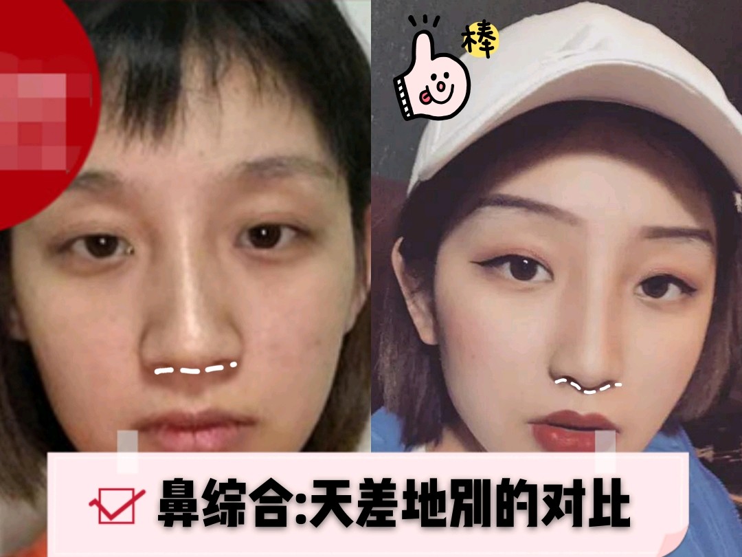 我的眼睛嘴巴什么的,都长得还挺好看的,就偏偏鼻子天生就有点扁,鼻梁