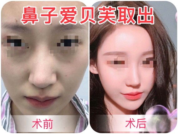 隆鼻后爱贝芙取出经历分享