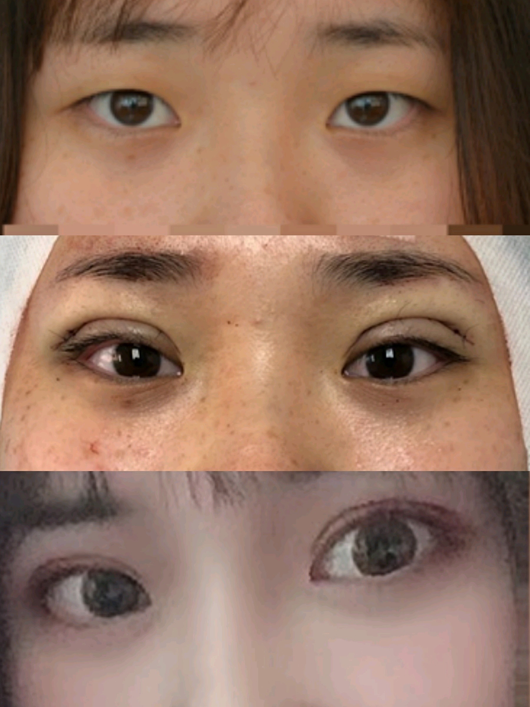 全切开扇双眼皮去皮去脂案例