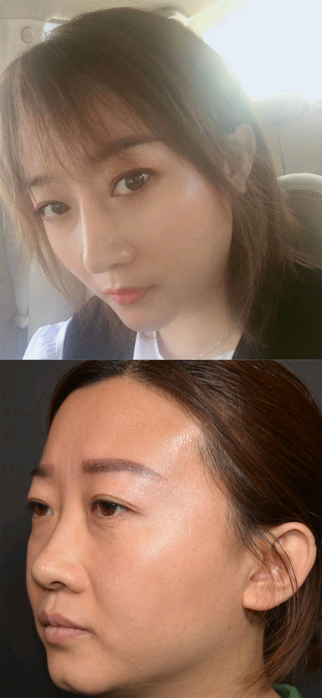 山根低,鼻梁窄的鼻子有救了,自然的肋软骨 膨体隆鼻_圈子-新氧美容