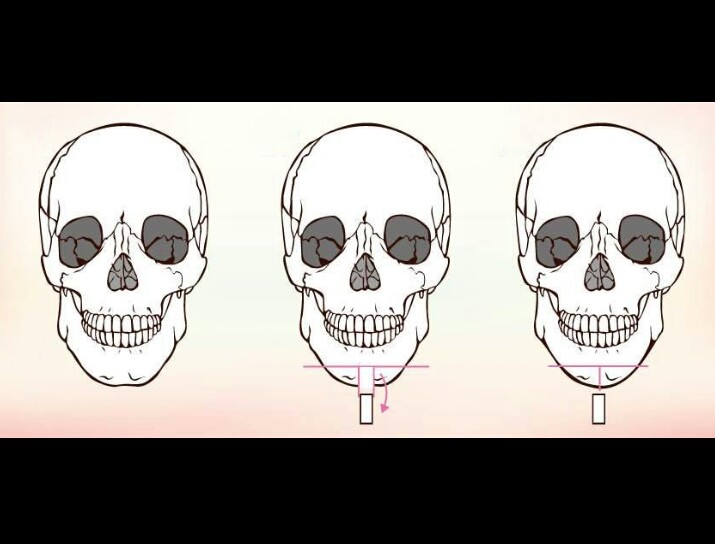 面部骨骼手术的两种方法