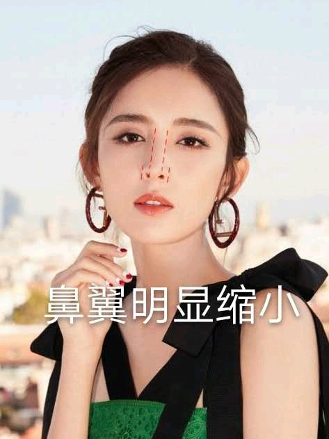 鼻翼缩小91近几年来,_圈子-新氧美容整形