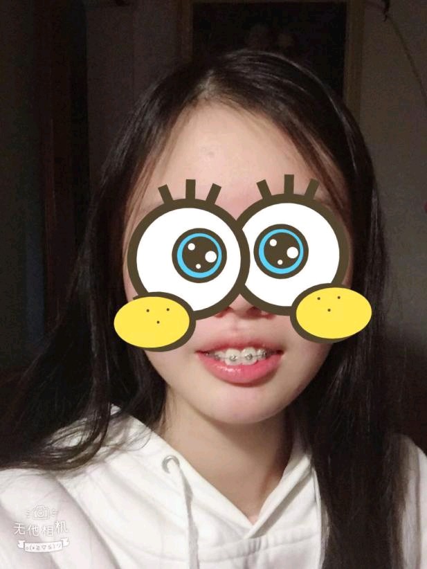 杭州牙齿矫正费用17岁小龅牙妮妮矫正牙齿短短4个月变化巨大