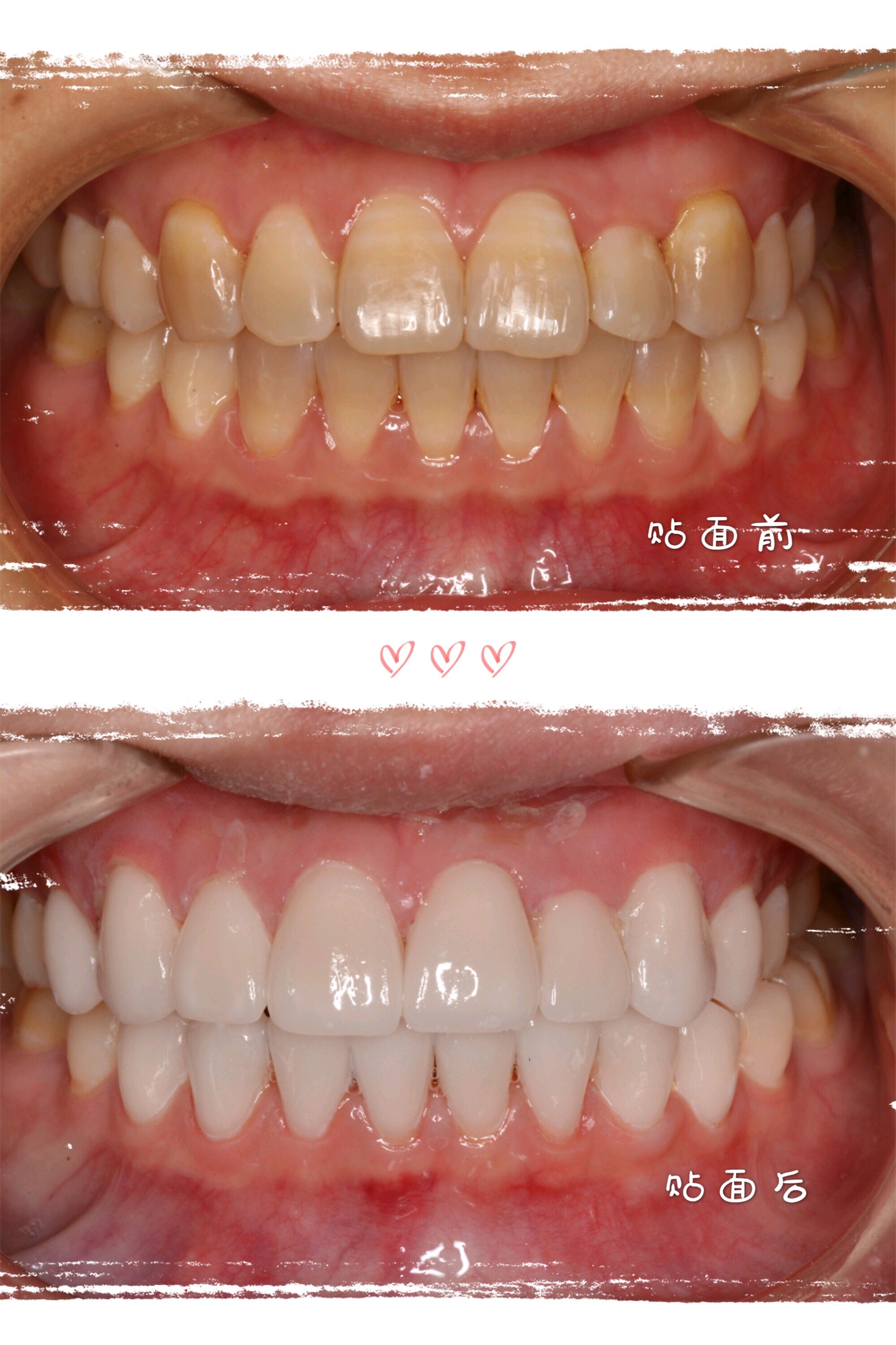 說說牙齒貼面 牙貼面是牙齒美白修復手術的一種,就是在本來染色牙葺