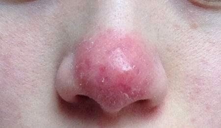 爱美之心人皆有之隆个鼻啥的已经再正常不过了不过有的_圈子-新氧美容