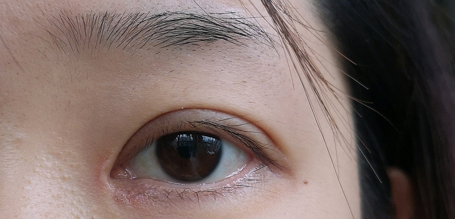 开眼角40天了眼角增生很明显也不知道是属于增生还是疤痕