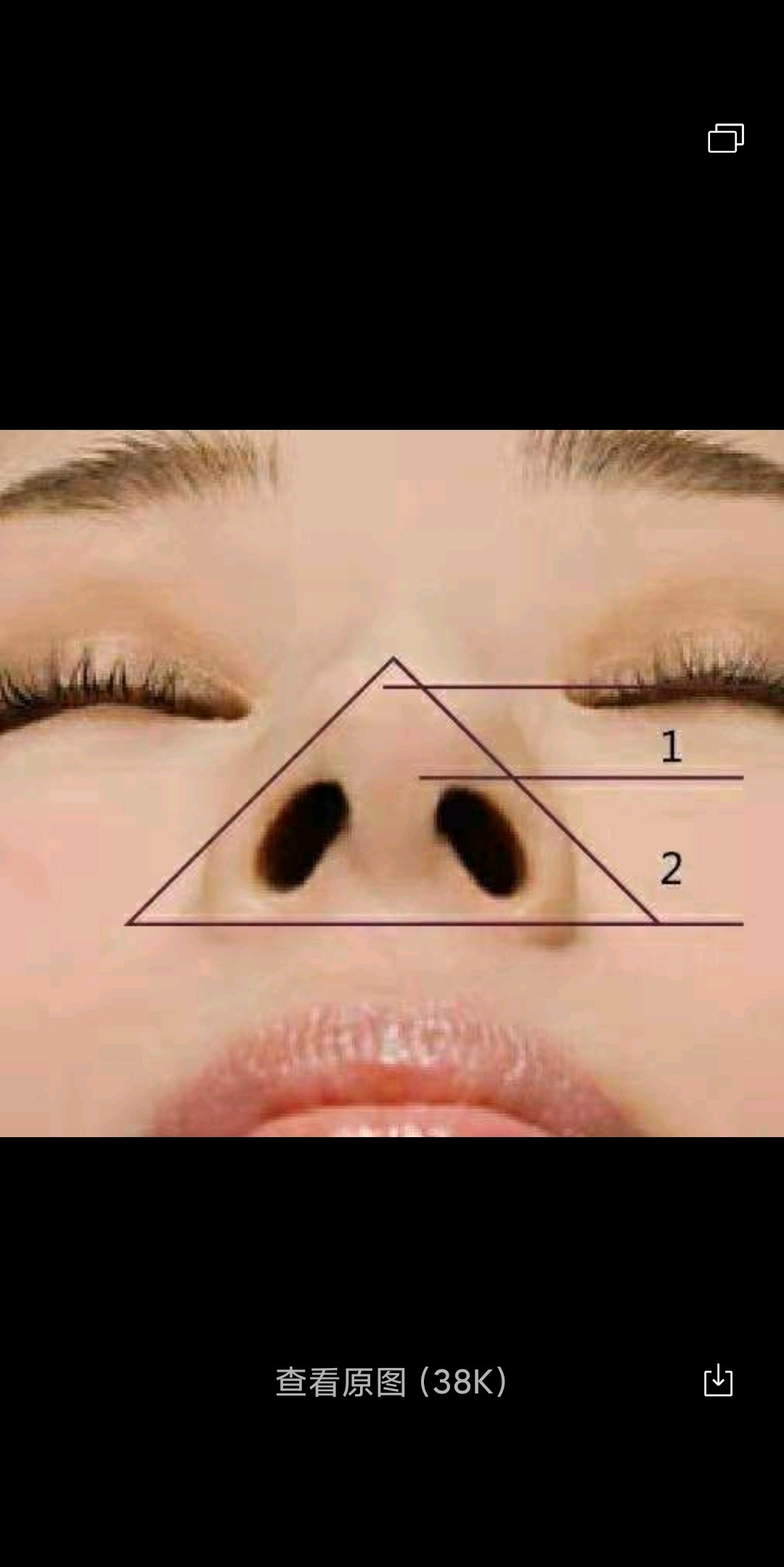 你仰头整个鼻小柱和鼻基底形状类似于等边三角形,鼻孔呈现水滴状