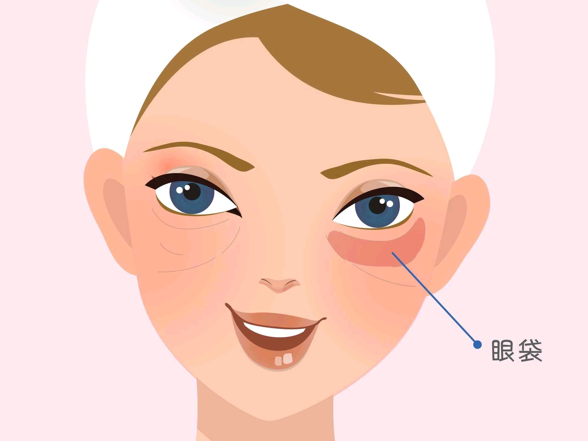 科普眼袋の形成