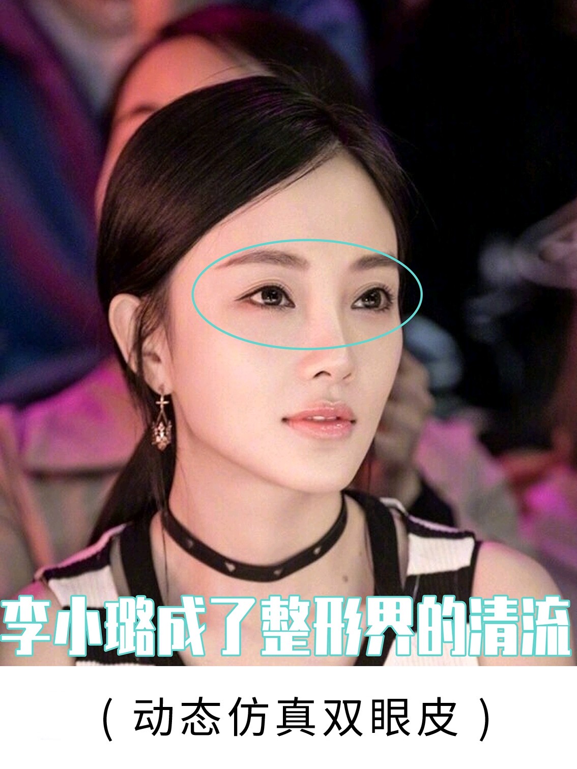 【你的脸型适合哪种双眼皮割多宽合适】