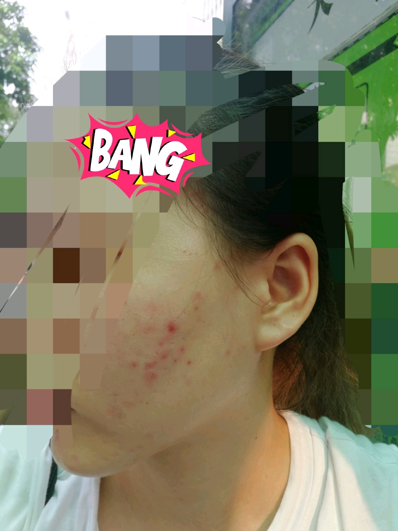 针清后闭口痘印对比