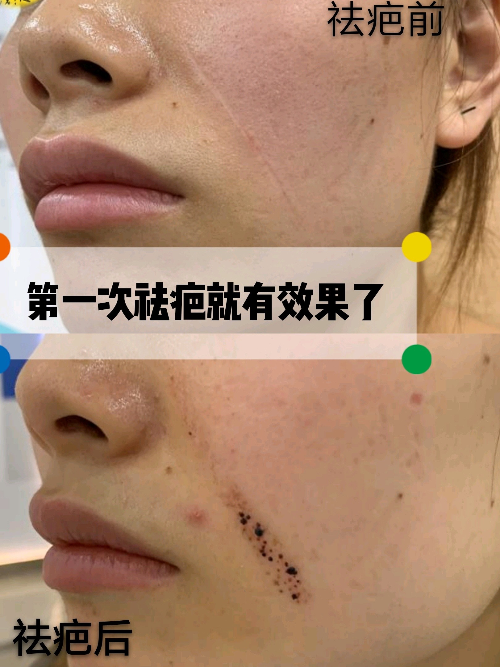 我是在重庆联合丽格做的激光祛疤 脸上这个疤痕其实已经
