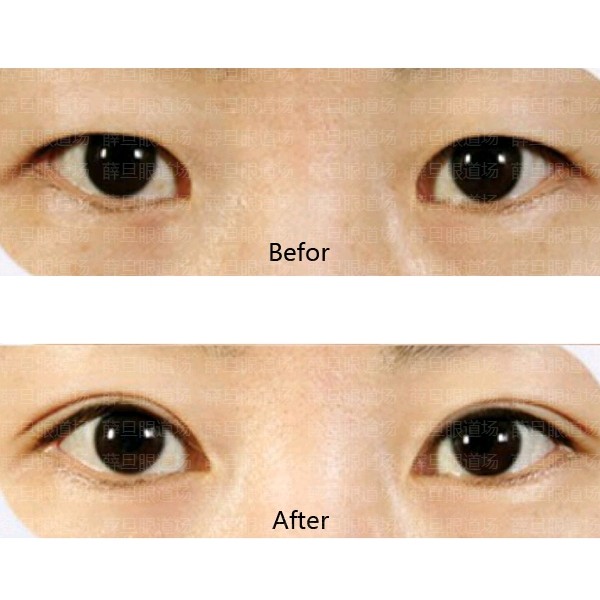 【双眼皮案例—内眦赘皮矫正】内眦赘皮是指在内眦角前_圈子-新氧美容