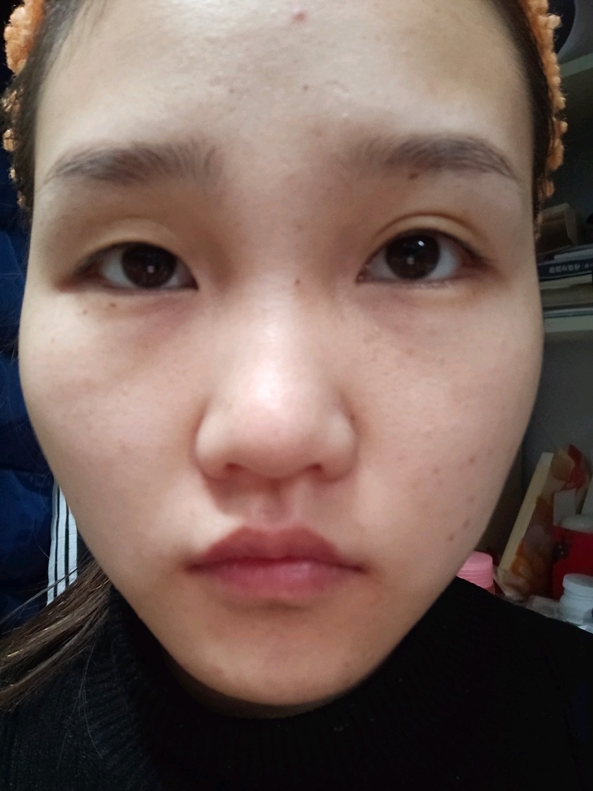 我的脸这是怎么了两边不一样颧弓外扩眼睛总感觉上下眼睑要黏在一起