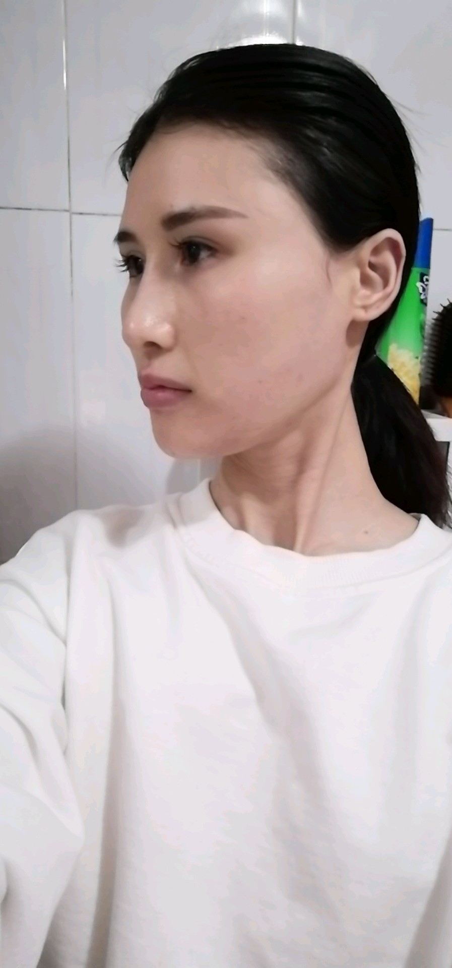 下巴打了溶解酶恢复原来边短了有点不适应下巴宽怎么改善啊必须t型截