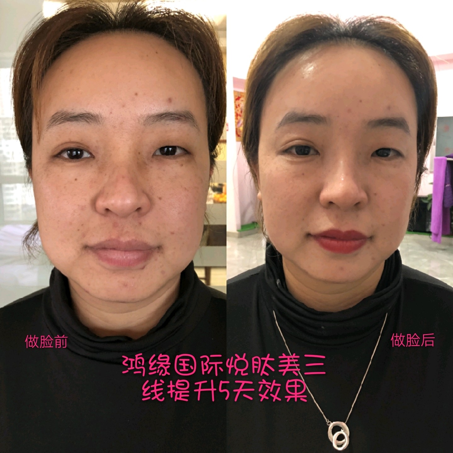 自黑一下98无针三线提升第一次第三天效果,大脸明显小_圈子-新氧