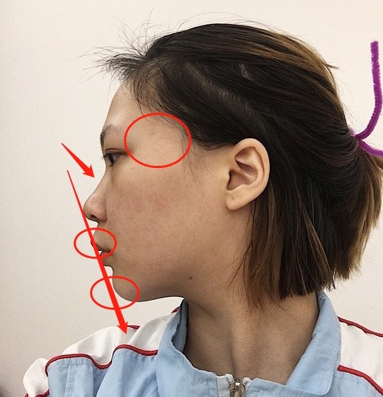 这位宝宝99正面视角山根较塌,宽鼻,鼻翼外扩,鼻基底_圈子-新氧美容