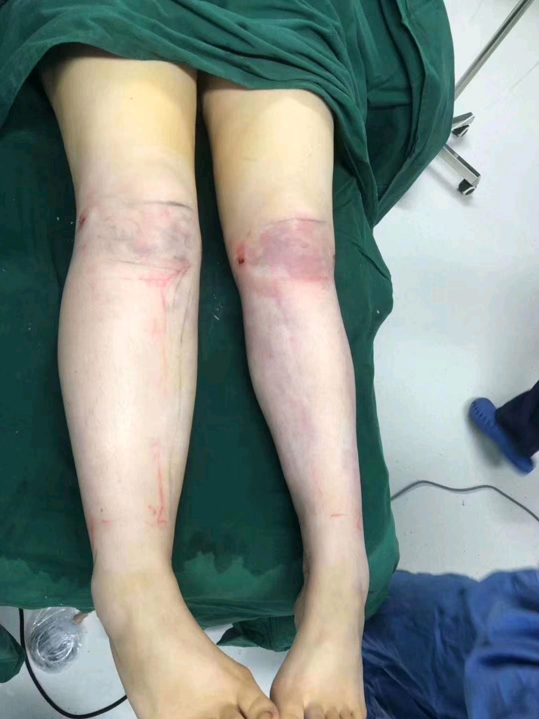 威塑小腿抽脂修复术后