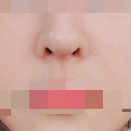 天生鼻翼缘退缩 鼻型不喜欢,要修复的天使宝贝们看过来!