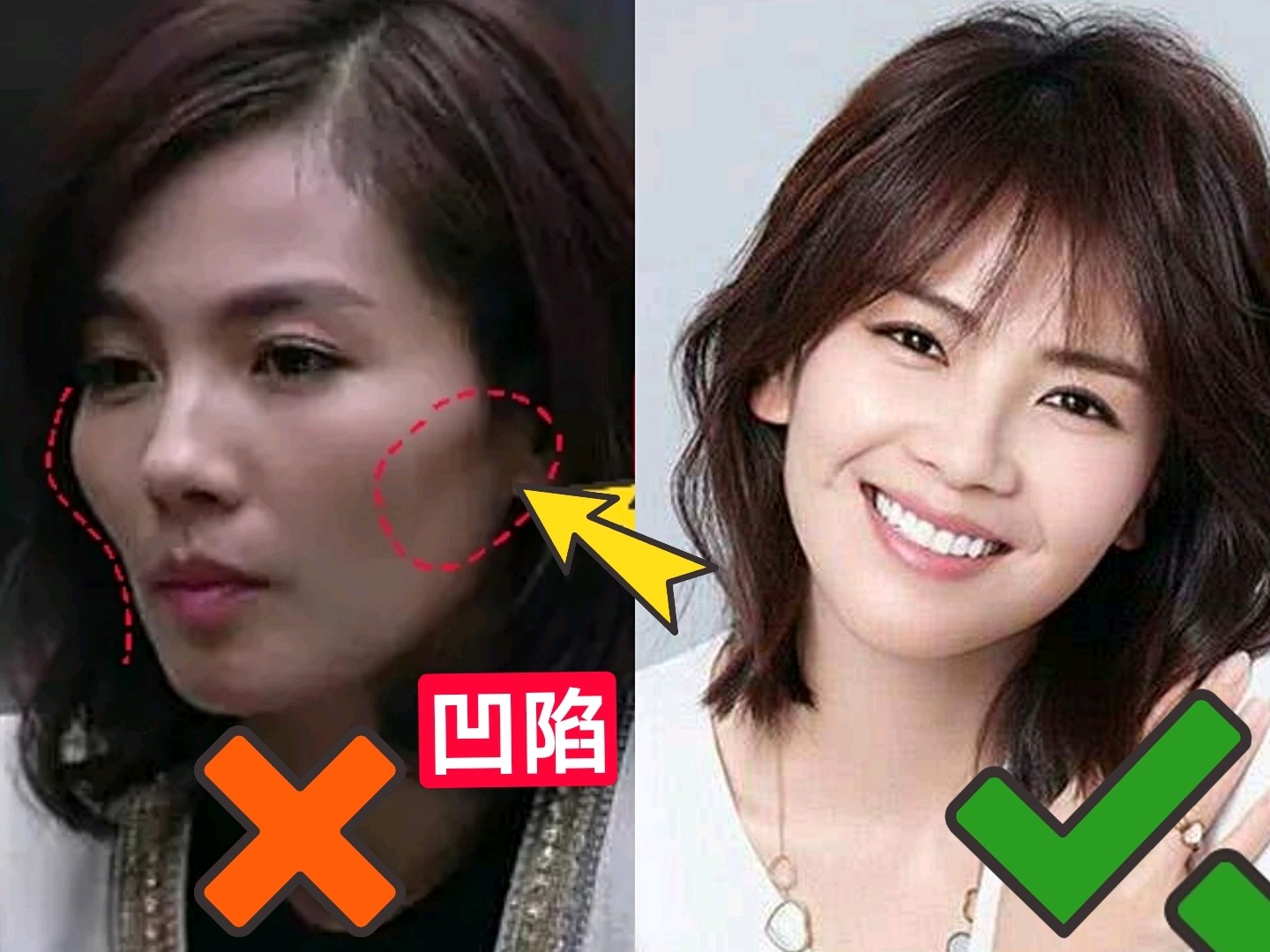 凹腮 面颊凹陷 棱角分明 刻薄老气 如何拯救