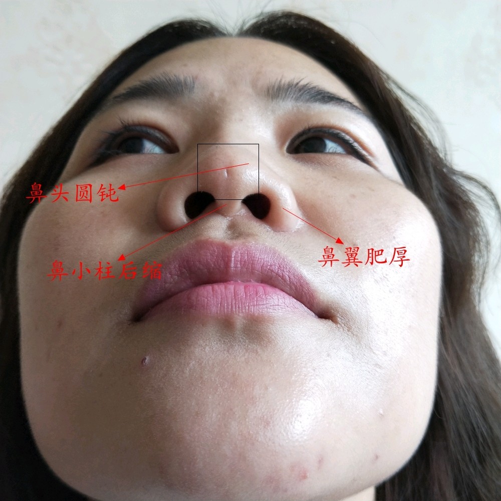 鼻子不够挺,山根低是很多朋友们心中的痛.