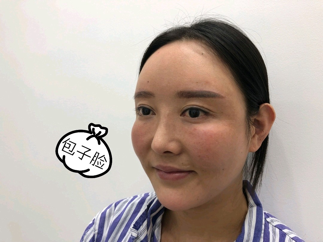 额头苹果肌面颊填充脂肪多了出现肿硬块修复分享