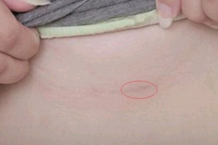 自体肋软骨隆鼻作为大多数医院主推项目,越来越受到大家的欢迎,它既