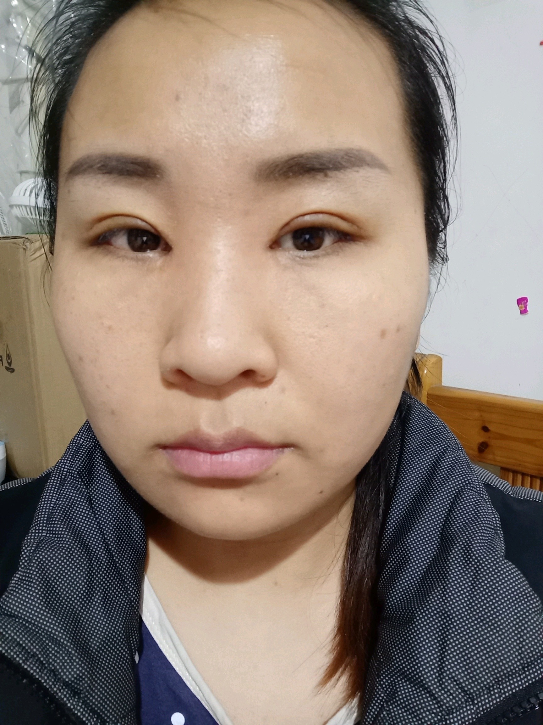 左眼角开坏了,真的每天都挠心挠肝了,不知道还能不能长小点,已经第10