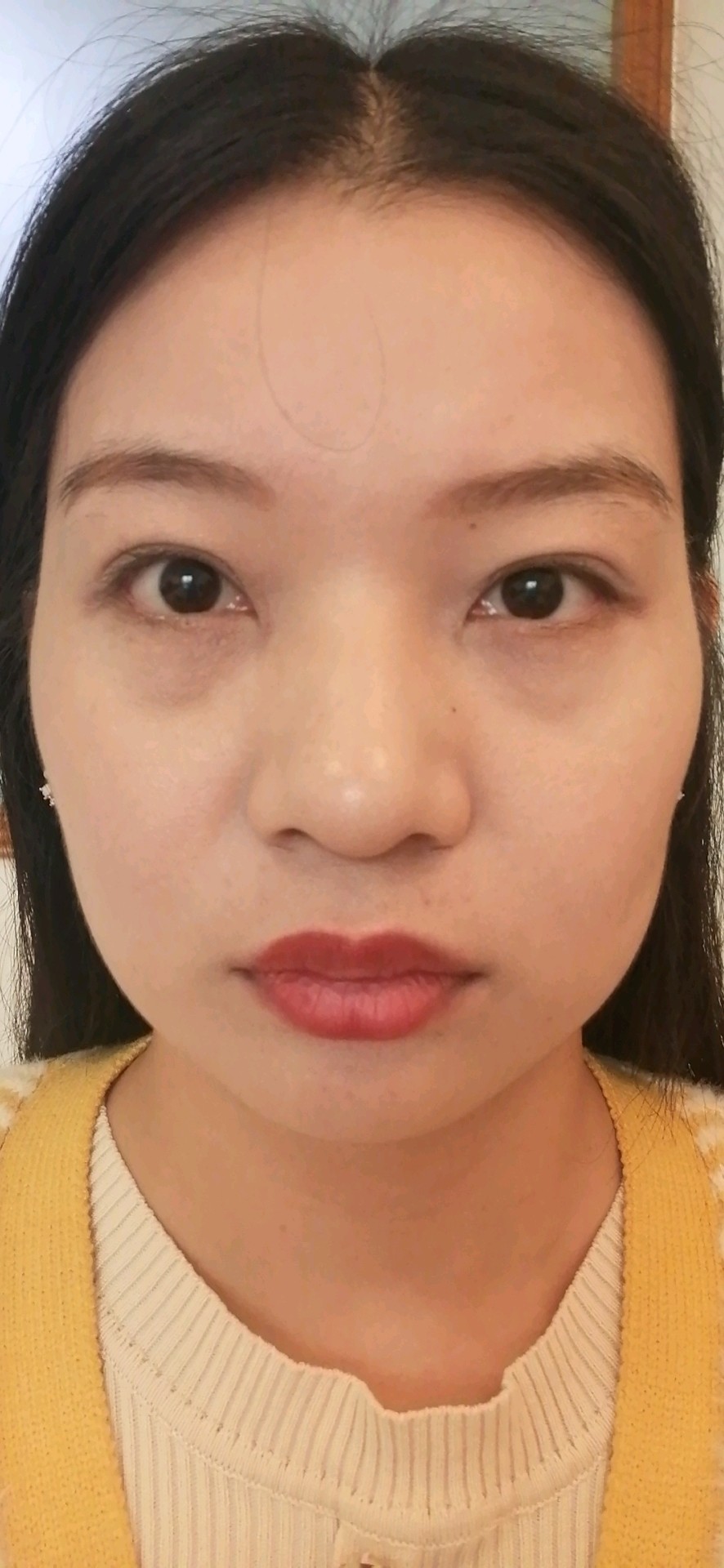 我这个到底是泪沟还是眼袋呢有卧蚕有严重黑眼圈