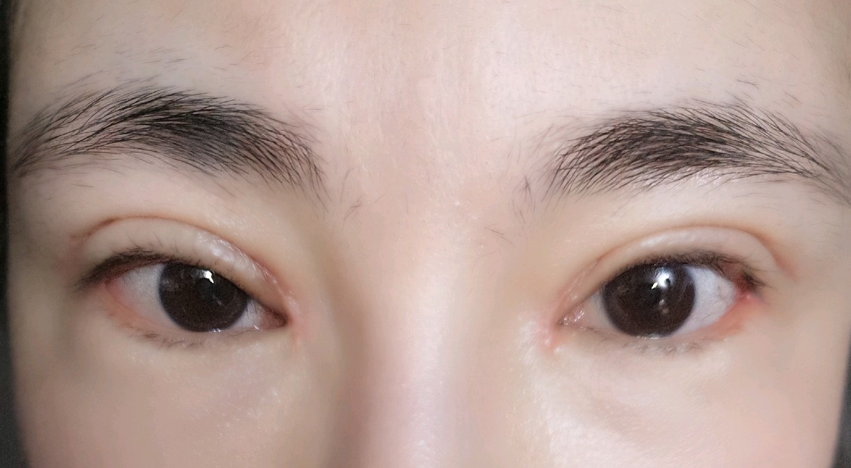 双眼皮手术一个月了,眼头低眼尾高,是不是失败了?