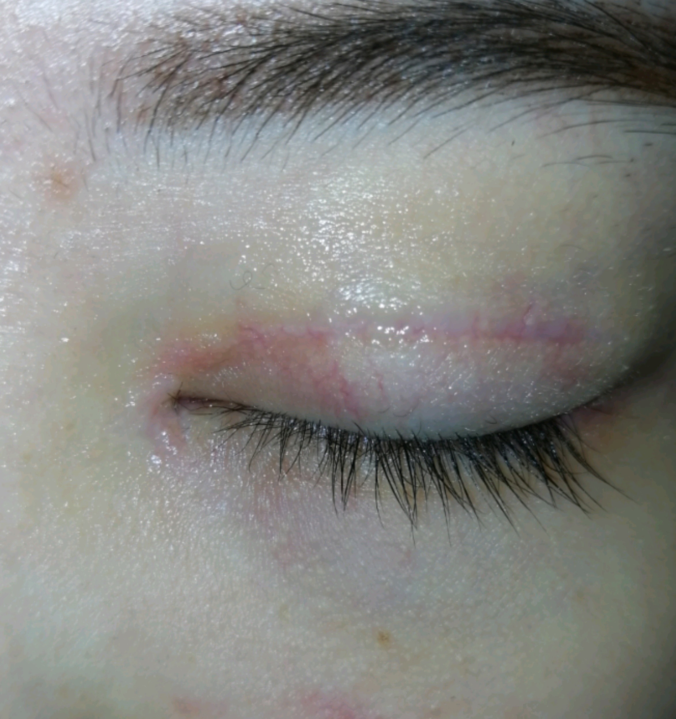 修复眼部五个月 一只眼睛肉条感重 宽 新氧美容整形