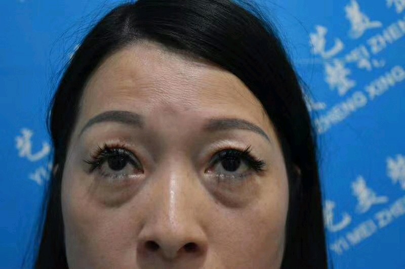 我的眼袋和泪沟终于没有了,现在特意来分享一下我去眼袋的经历