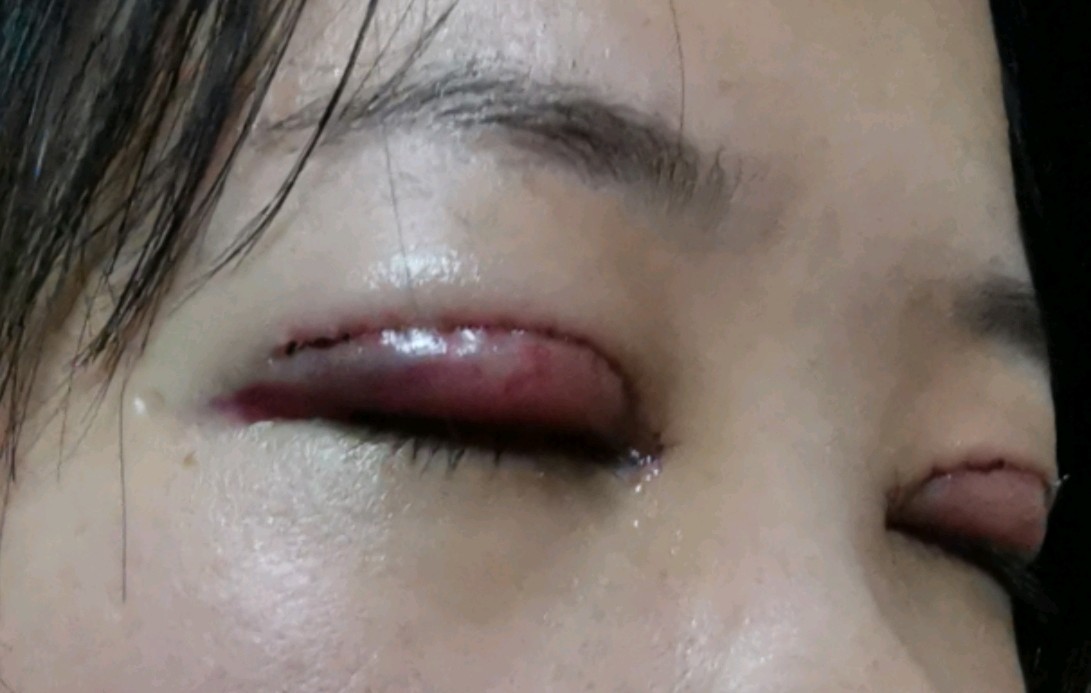 术后一两天眼睛非常红肿