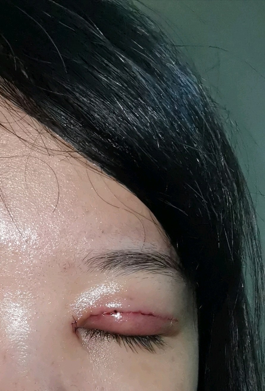 不小心拉扯绷到双眼皮缝线处怎么办