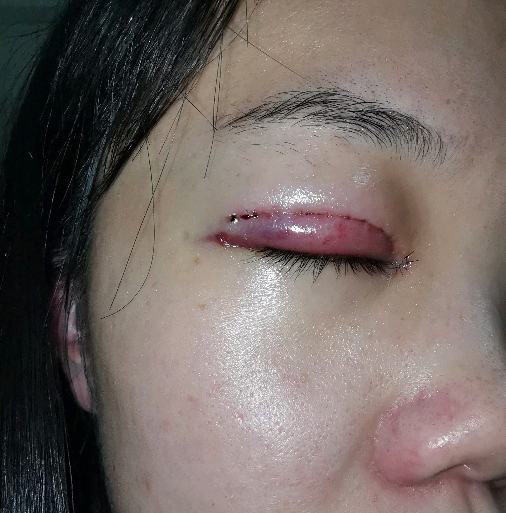 不小心扯到绷到双眼皮缝线处,痛了一下还渗血了,会有不良效果吗?