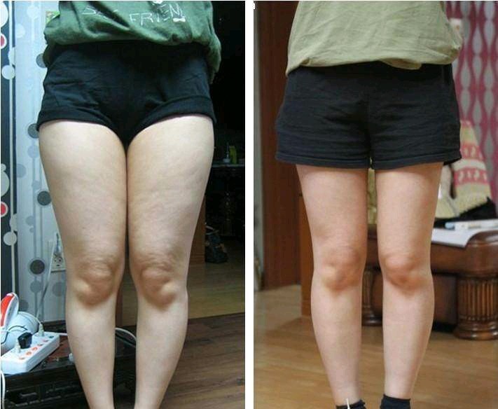 大腿内腿部吸脂切口在哪?别找了都在这篇文章里