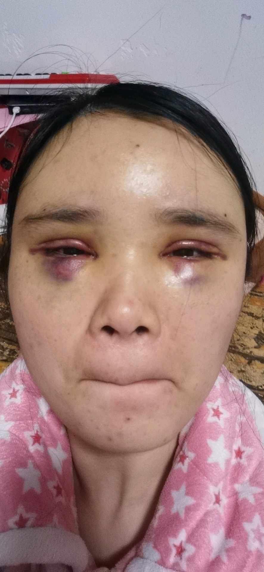 做完眼睛和全脸填充,经期提前了