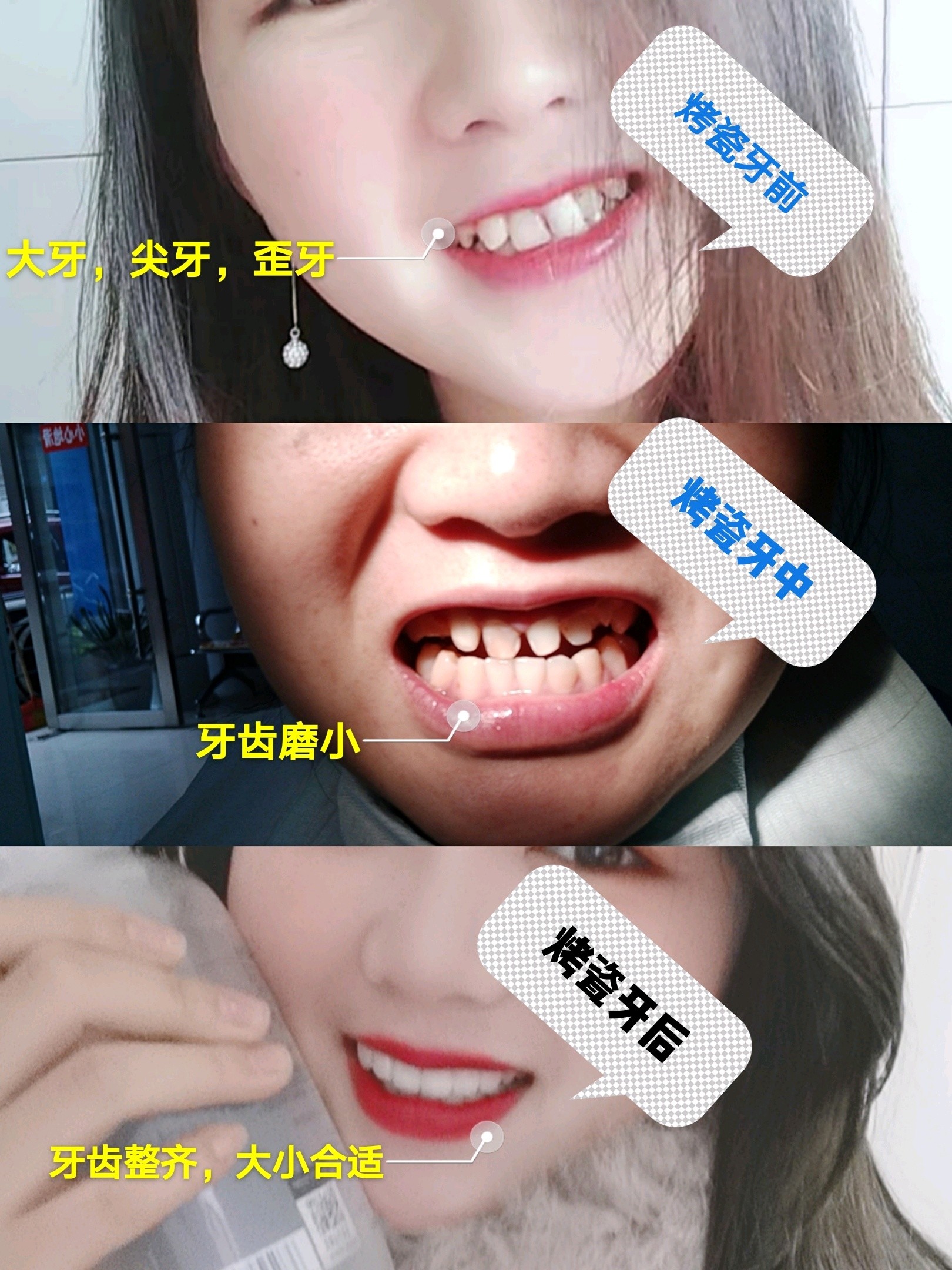 烤瓷牙 只要一个月就让你拥有一口整齐好牙 多年 圈子 新氧美容整形