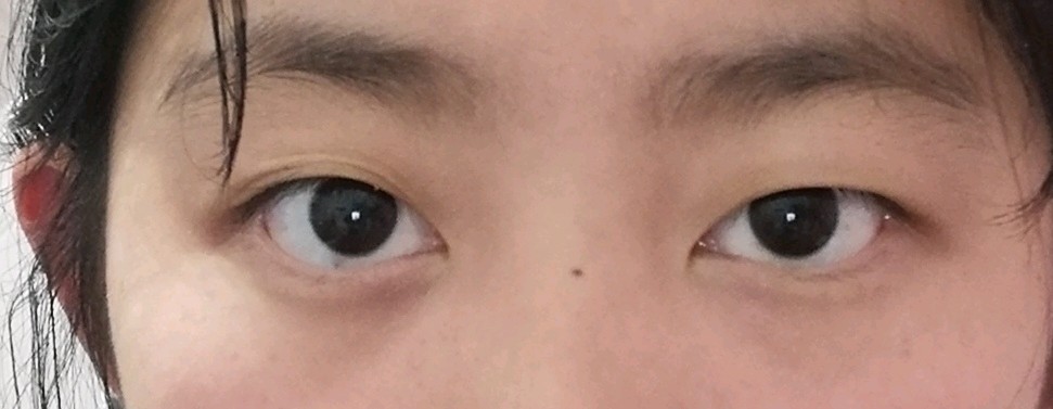 大小眼怎么办05