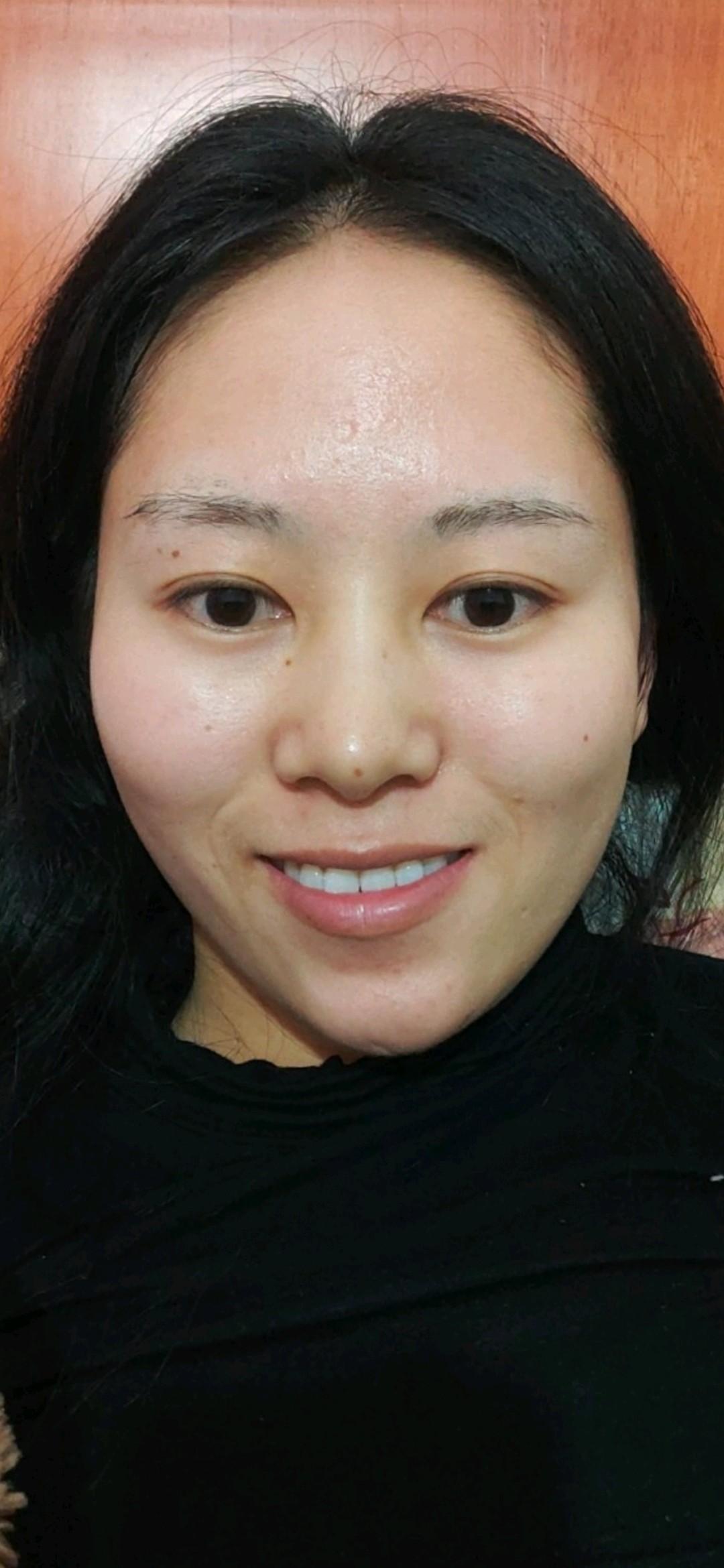 脸部偏颌,咬肌不正.太阳穴凹陷