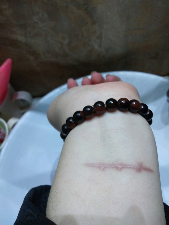 凹陷性的疤痕可以通过微针,点阵激光治疗来改善;凸起的瘢痕目前没有太