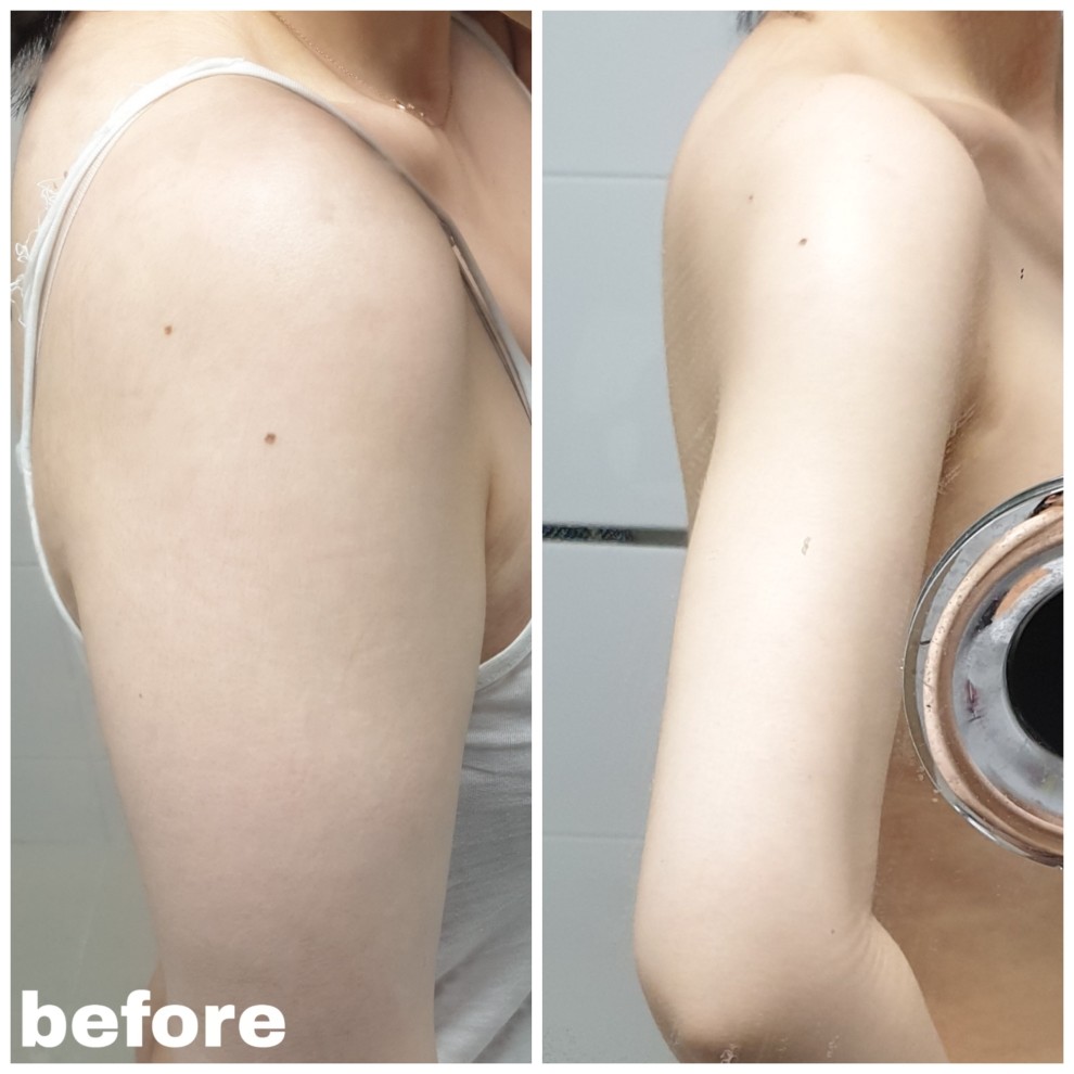 做完手臂吸脂过了3周术前看着惊人的案例效果还在怀疑_圈子-新氧美容