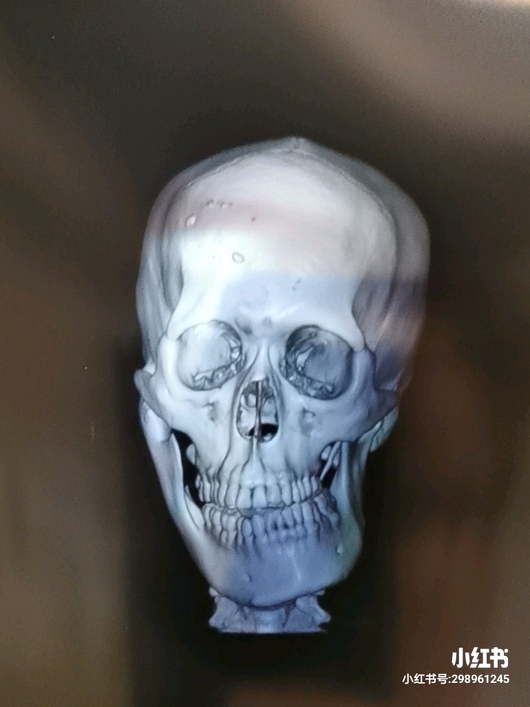 这个是我们医院的何晋龙教授和王涛教授共同完成的一个病例