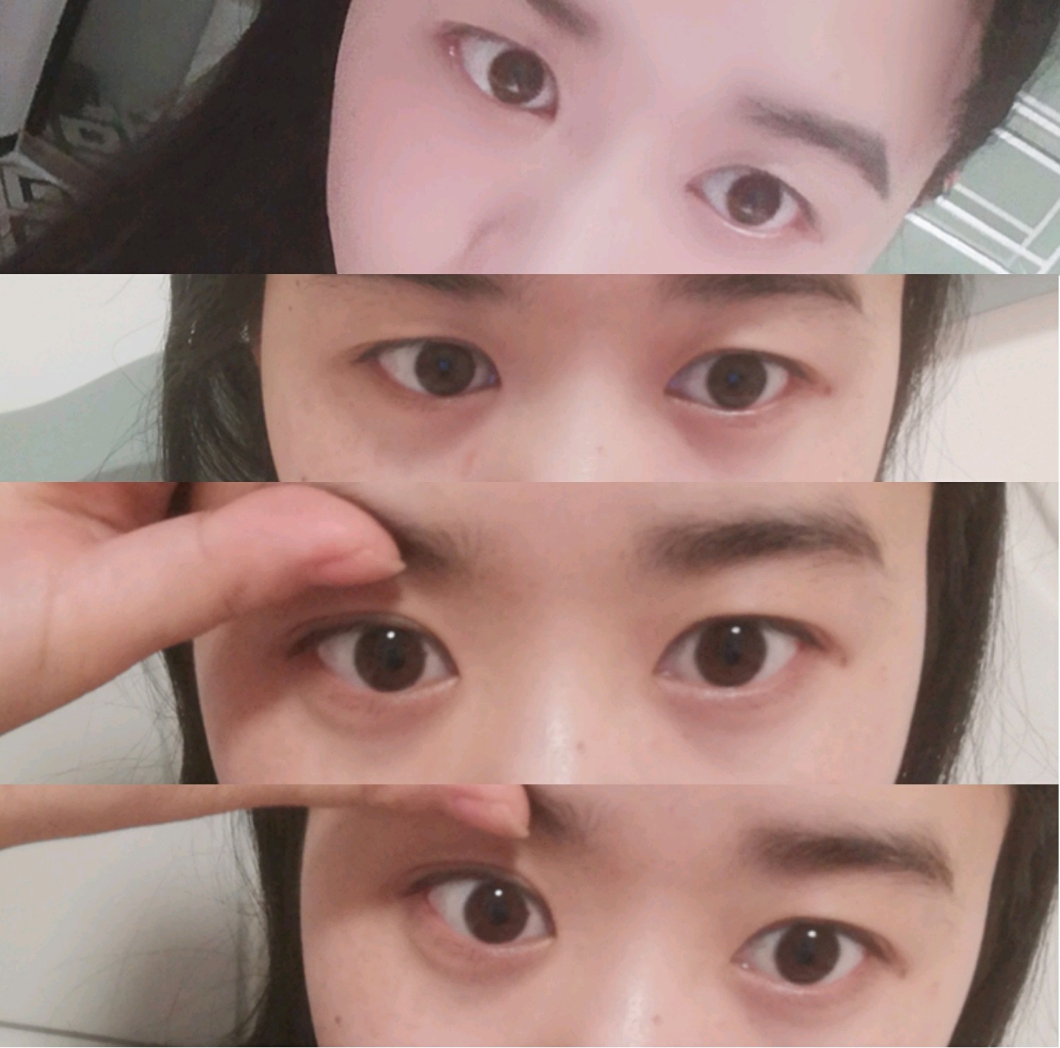 本身是双眼皮上眼睑有一些下垂是眼睑去脂好还是做全切双眼皮