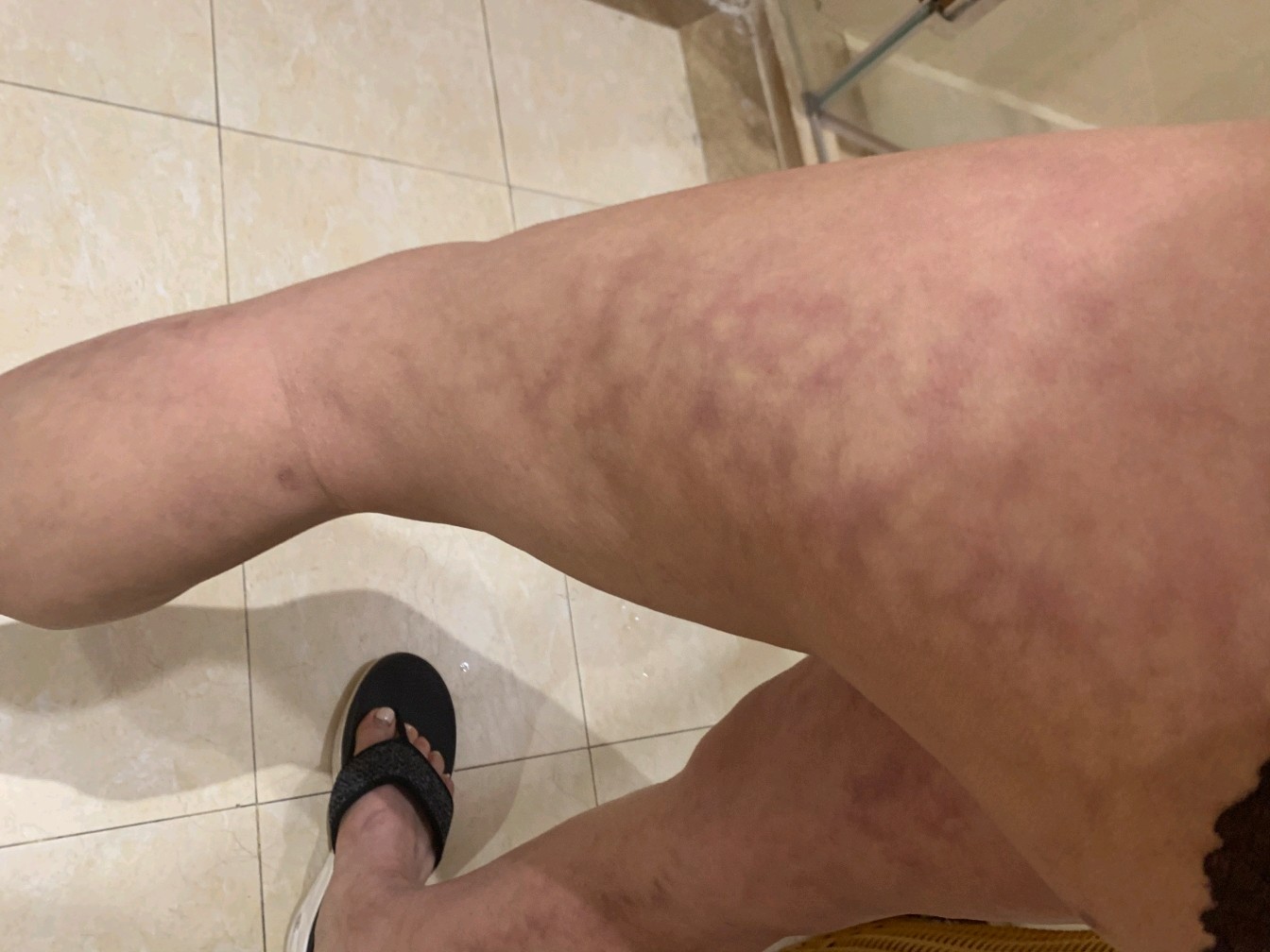 大小腿吸脂一年后腿上有这种纹路是怎么回事还会消退吗