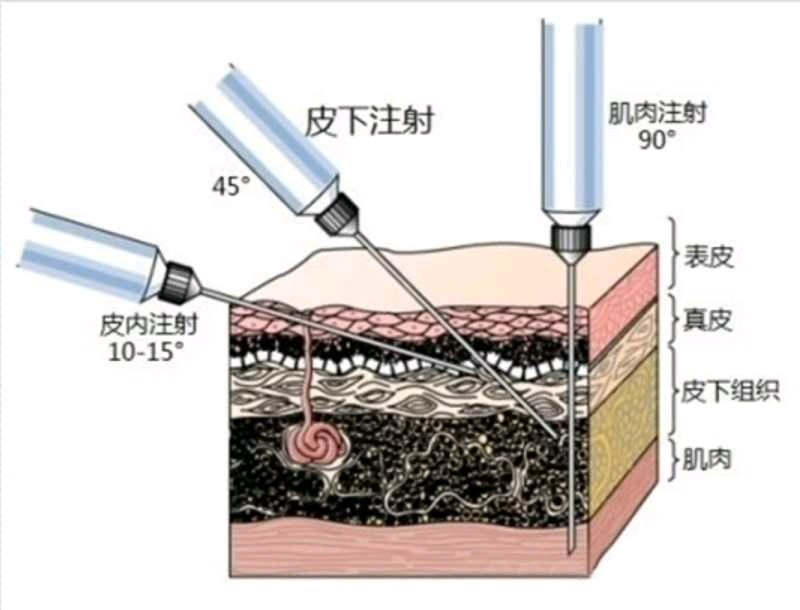 皮肉注射,皮下注射,肌内注射示意图