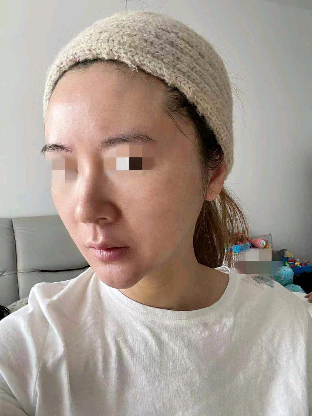 韩国大拉皮术后第7天